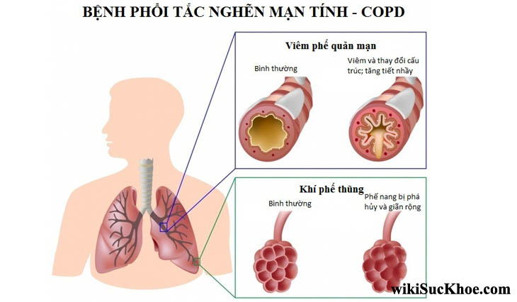 Bệnh tắc nghẽn phổi mãn tính